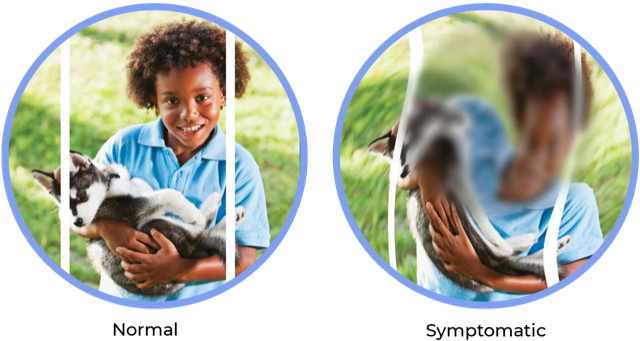 Comparison of normal and AMD symptomatic vision