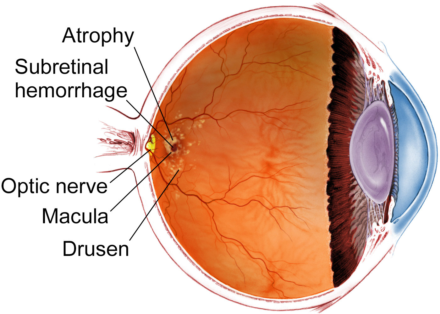 Anatomy of eye with damage from age-related macular degeneration