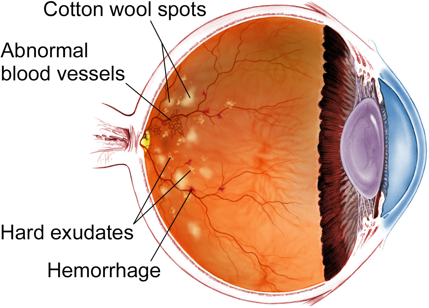 Anatomy of eye with damage from diabetic retinopathy